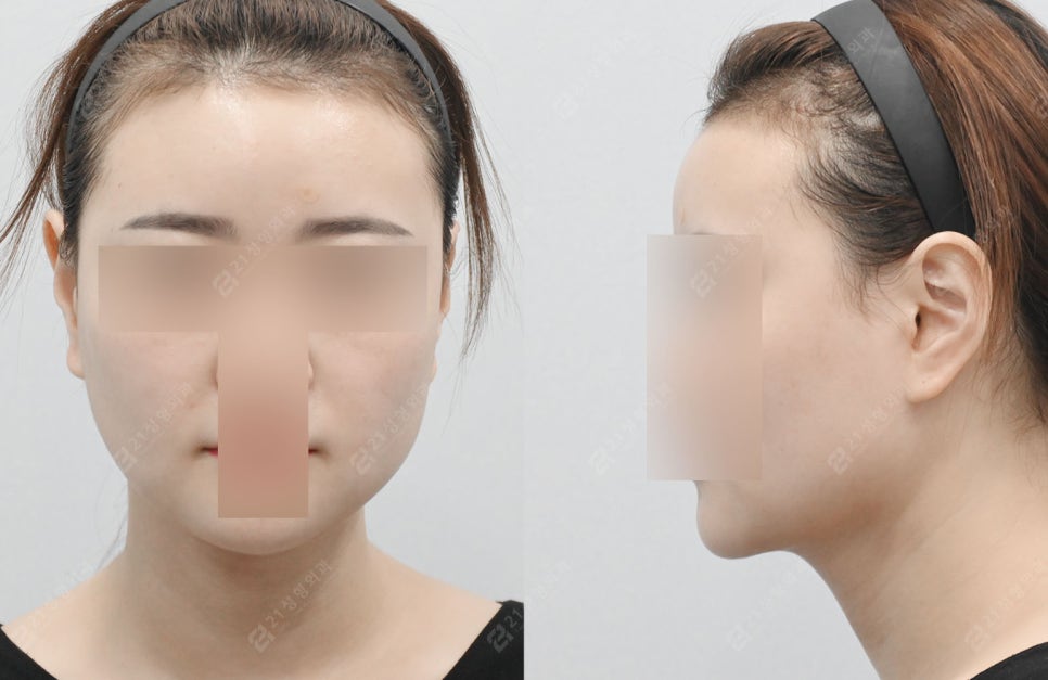 이중턱, 지방만 빼면 끝? 진짜 해결 방법과 실제 환자 전후 비교 관련 이미지 4