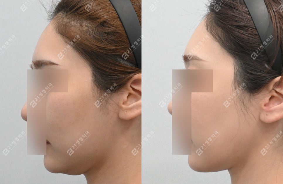 Before and After Cheekbone Reduction: Changes in Facial Width (4 Months · 1 Year) image 8