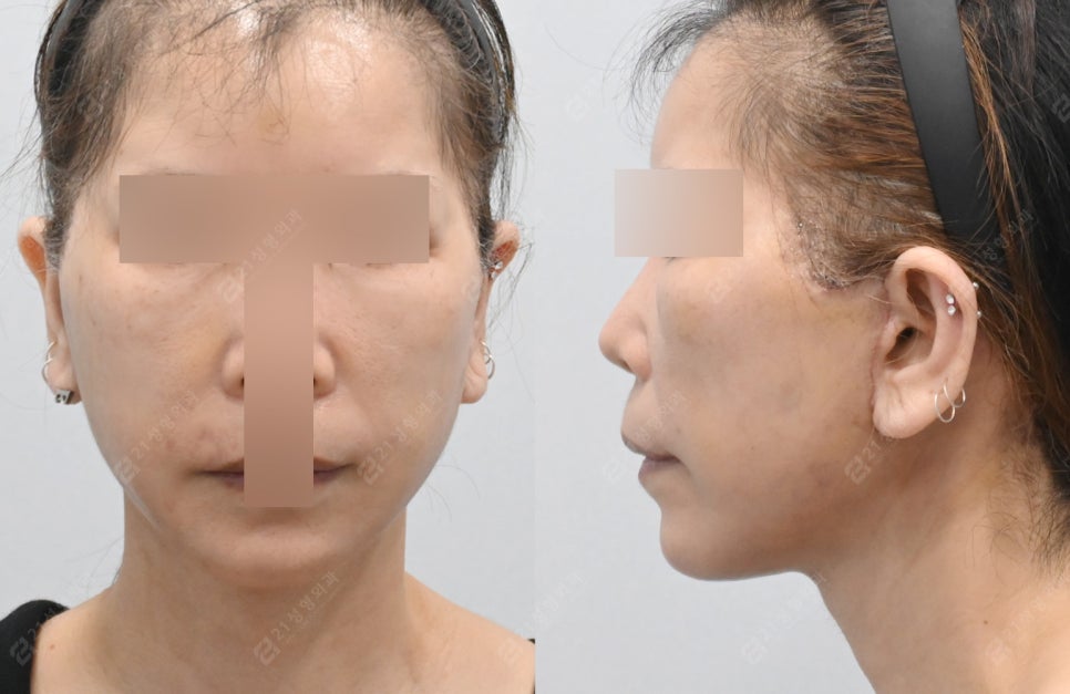 Facelift Surgery Without a Pulled Earlobe: A Real Patient Review image 5