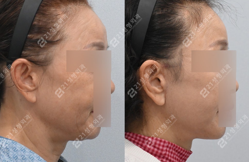 이렇게나 달라져요? 전후 차이 확실한 안면목거상 관련 이미지 3