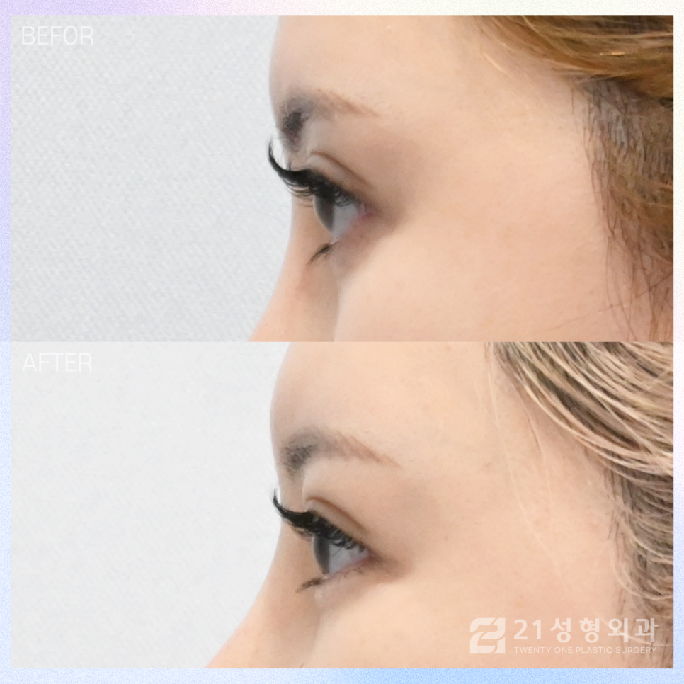 눈밑자가지방이식만으로 볼륨 있는 눈매 만들기 관련 이미지 3