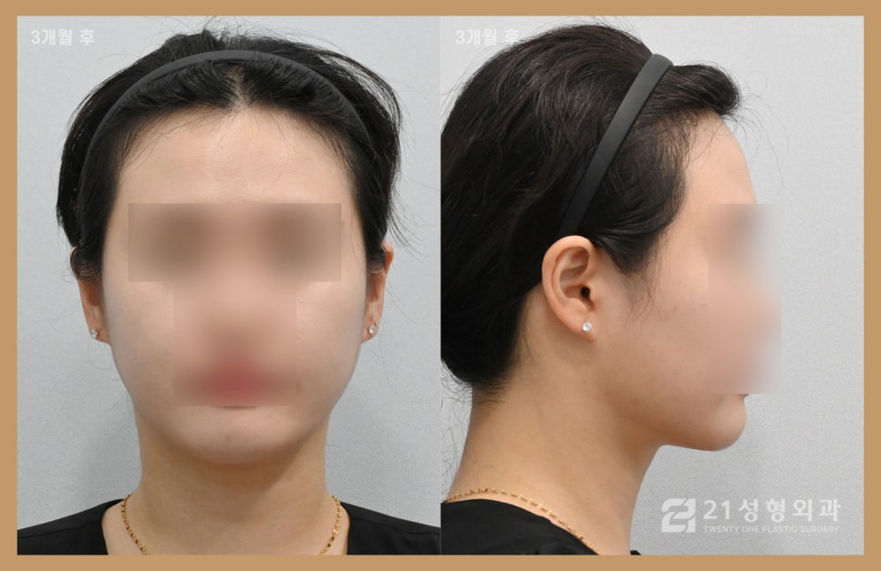 이중턱지방흡입부기 과정이 궁금하다면 관련 이미지 7