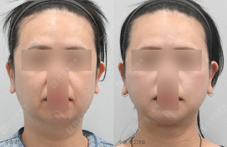 Why Does My Face Still Look the Same Even After Having Many Lifting Procedures? image 1