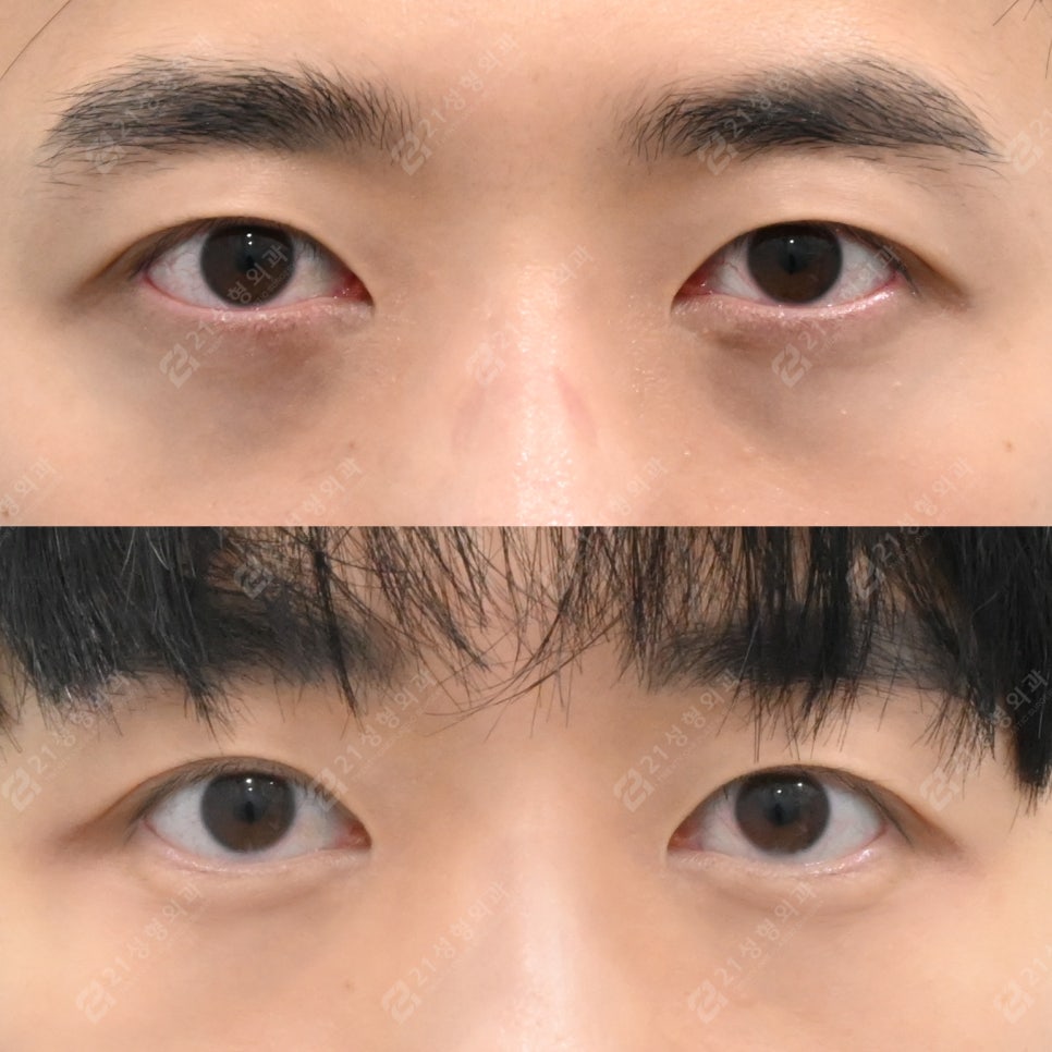 Before-and-After Case of Lower Eyelid Fat Repositioning Surgery for Men image 5
