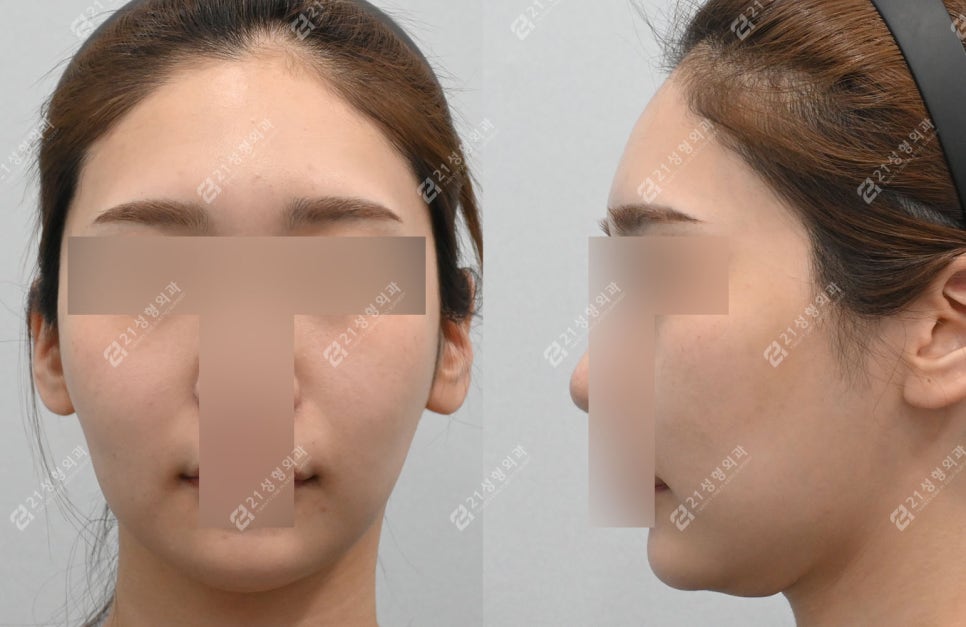 Before and After Cheekbone Reduction: Changes in Facial Width (4 Months · 1 Year) image 4