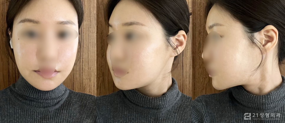 이중턱근육묶기수술 후 땡김이 사용 방법 관련 이미지 5