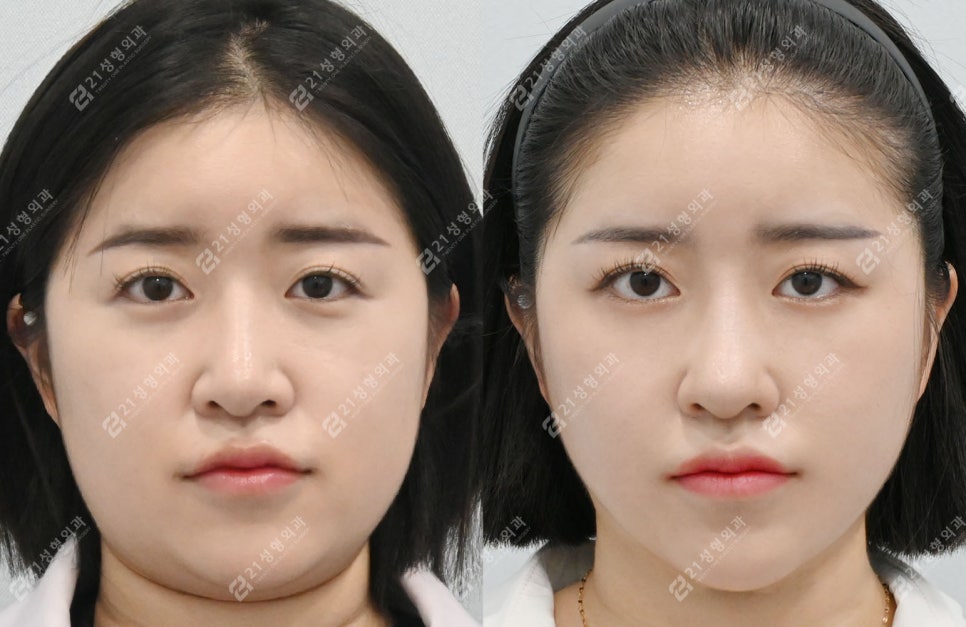 코성형 후 인상이 달라진 이유, 얼굴 중심의 차이 관련 이미지 5