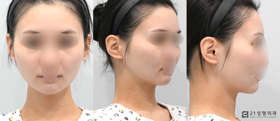 얼굴자가지방이식수술 유지기간과 효과 관련 이미지 5