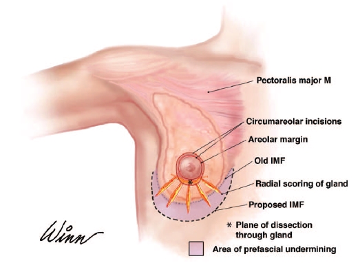 관상형 유방 (Tubular breast) 관련 이미지 9