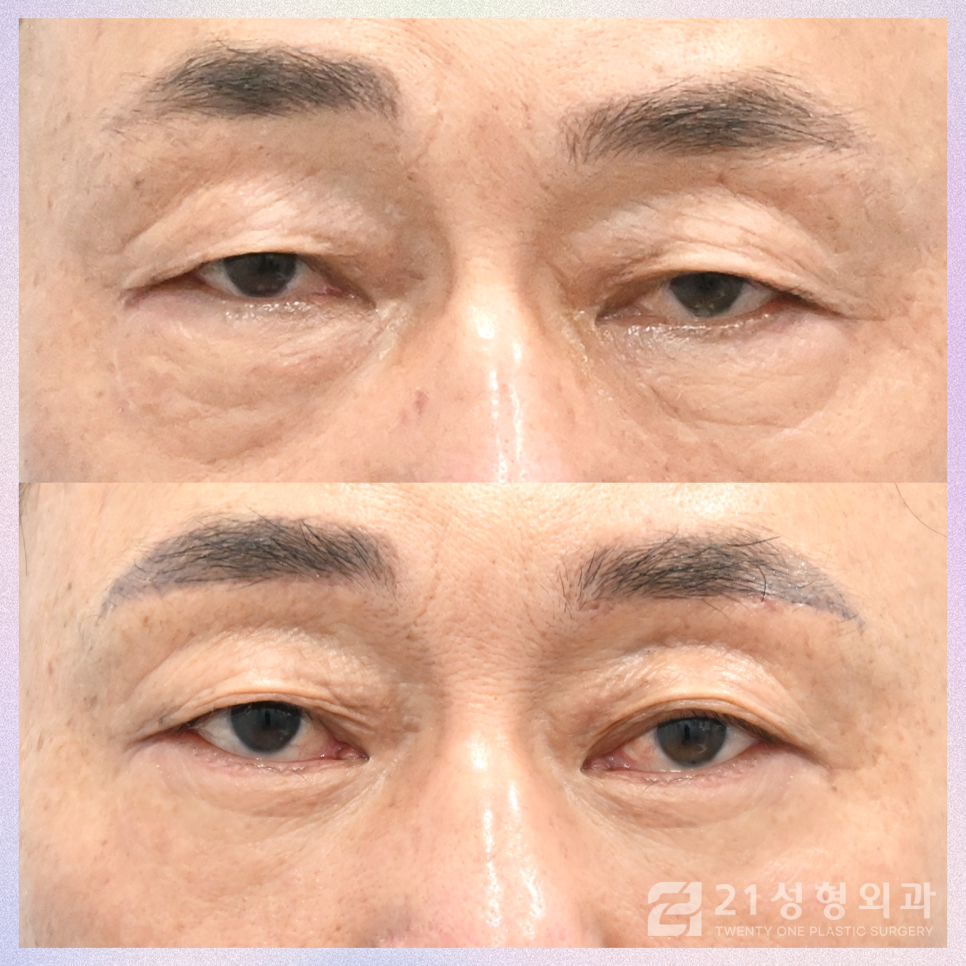 중년눈수술, 젊어지기 위해 필요한 것은 이것입니다 관련 이미지 1