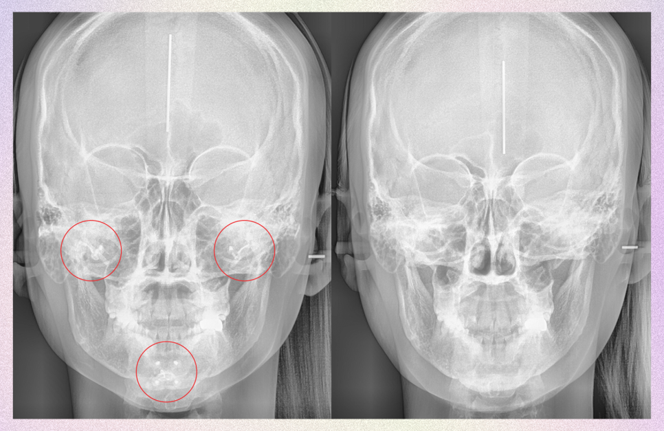 윤곽핀제거수술 제거해야 되는 기준 관련 이미지 1