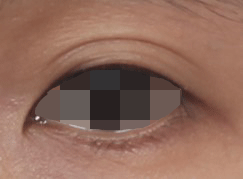 [눈 성형] 높은 쌍꺼풀 낮추기 관련 이미지 5
