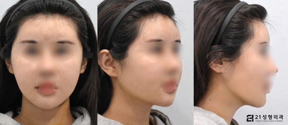 투턱없애기 이중턱근육묶기로 해결 관련 이미지 4