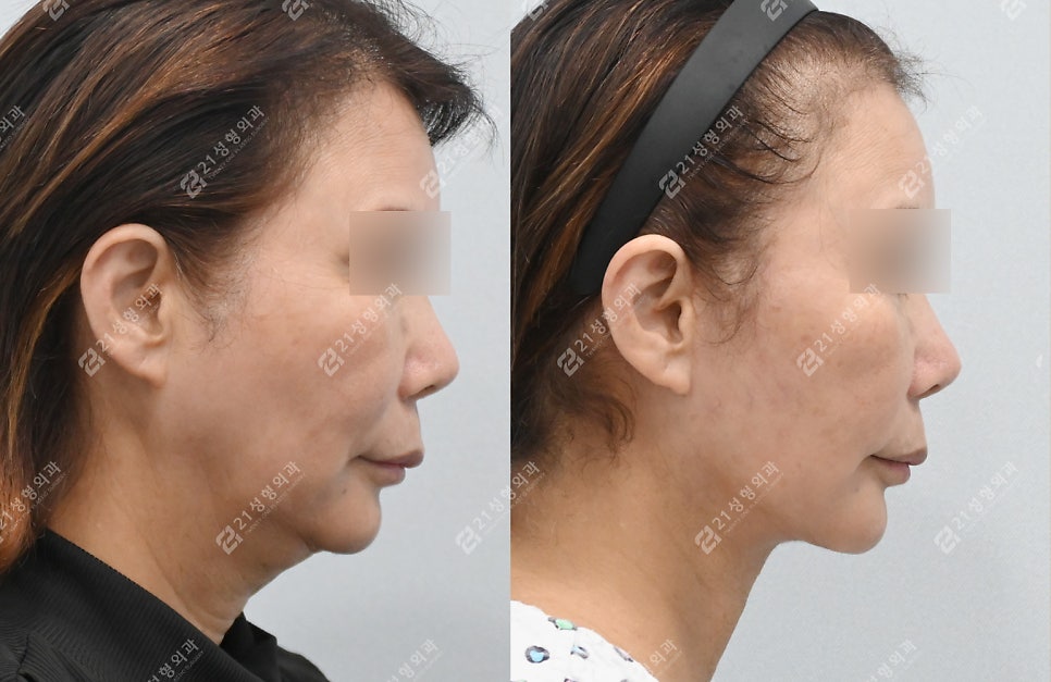 Mid-Face Lift Revision Surgery Case in a Patient in Their 60s image 4