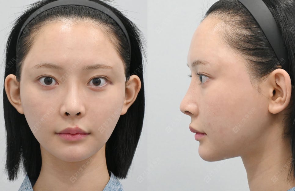 Facial Contouring, Key Points You Must Know: A Real Review of Changes Over 1 Year and 6 Months image 6