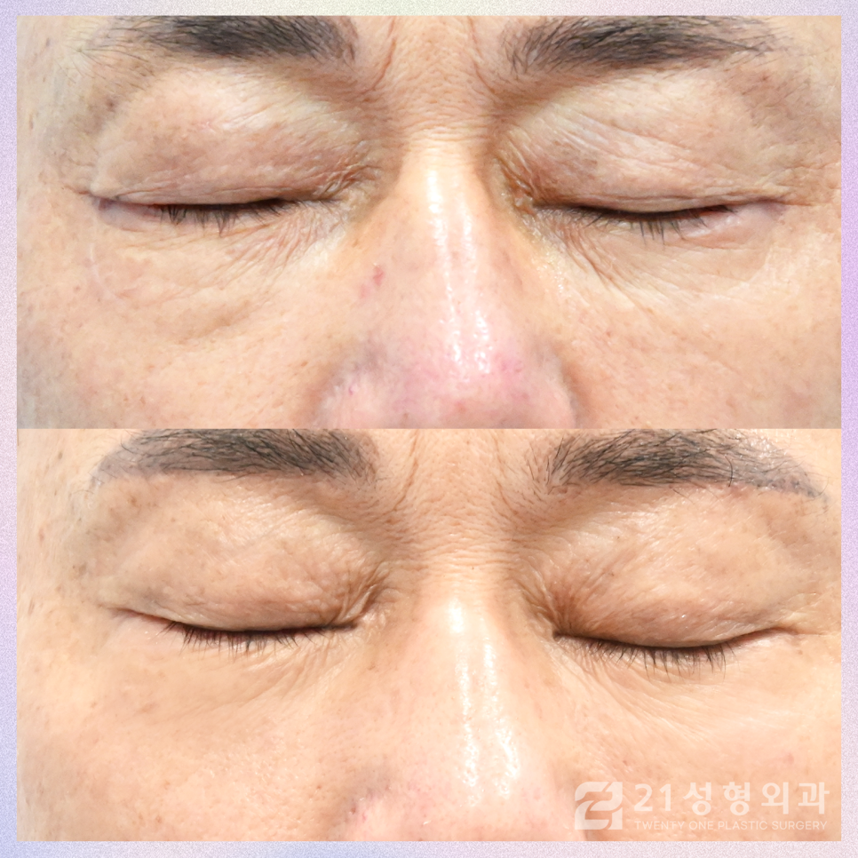 강남하안검수술 처짐 없는 동안 눈매를 위해 관련 이미지 2