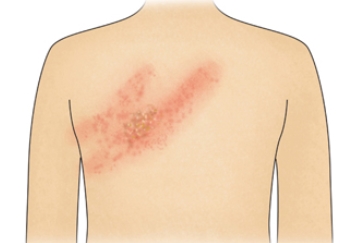 [항 바이러스제] Acyclovir(아시클로버) & Valaciclovir(발라시클로버) ③ 관련 이미지 6