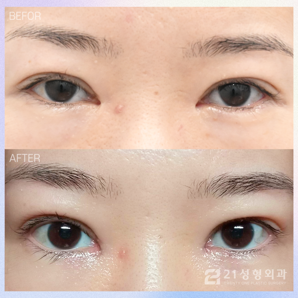 앞트임복원수술 자연스러운 눈매로 재탄생 관련 이미지 1