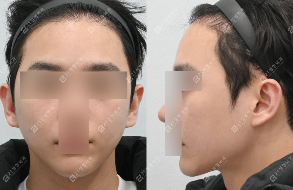 살은 안 쪘는데 왜 이중턱만 남을까? 남자 이중턱의 진짜 원인 관련 이미지 4