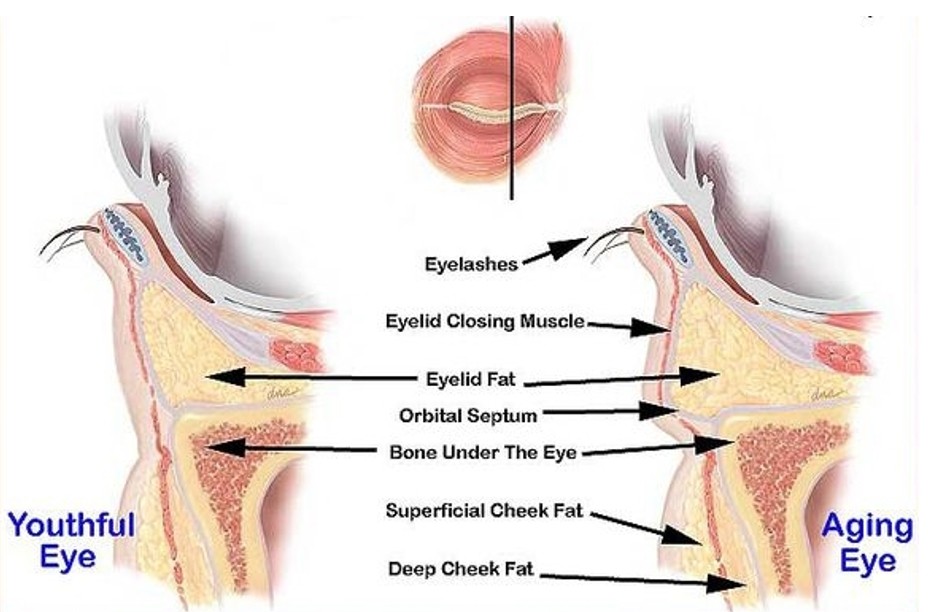 With Lower-Eyelid Fat Repositioning and Fat Grafting: The Real Reason Your Eyes Look Different image 3