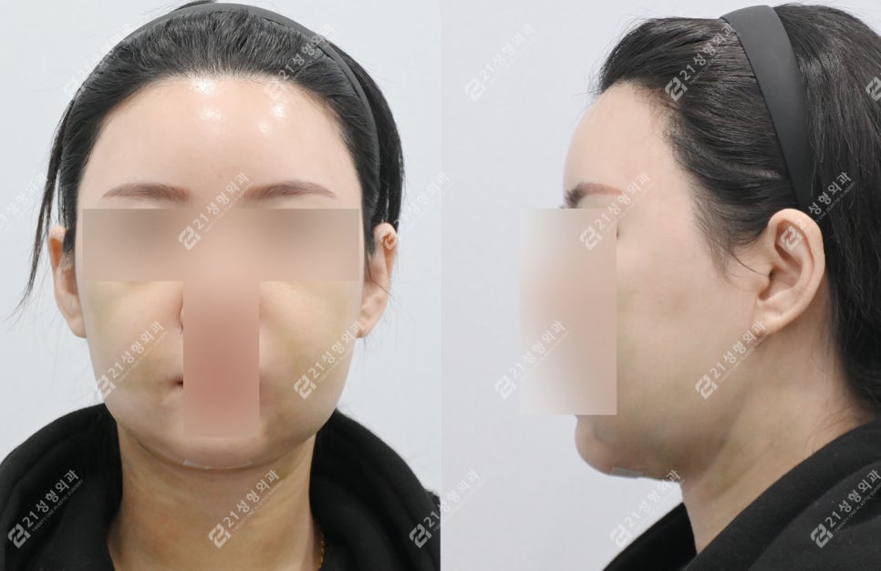 이중턱 수술 후 딱딱함&middot;울퉁불퉁 피부, 괜찮은걸까? 관련 이미지 3