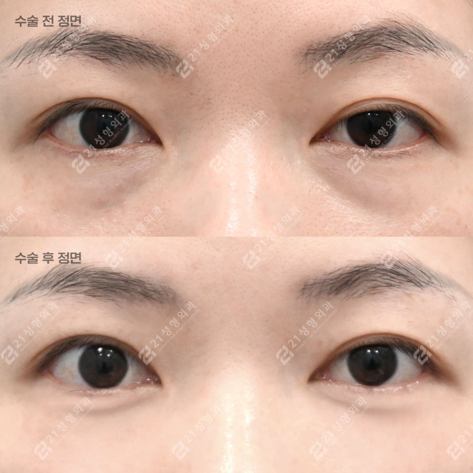 눈밑지방재배치, 30대인데 피곤해 보이는 이유 관련 이미지 3