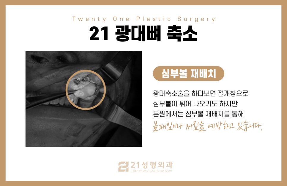 옆광대수술 전 필수로 확인해야 하는 것 관련 이미지 5