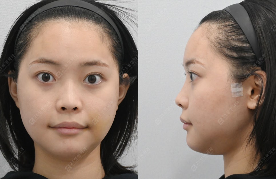 Facial Contouring, Key Points You Must Know: A Real Review of Changes Over 1 Year and 6 Months image 4