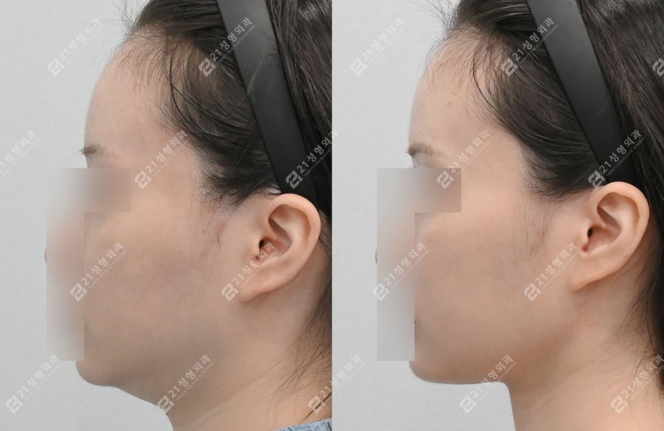 The Reason a Double Chin Appeared After Surgery Was Not a Fat Problem image 6