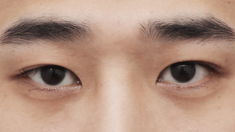 [눈 성형] 낮은 쌍꺼풀 높이기~ 관련 이미지 2