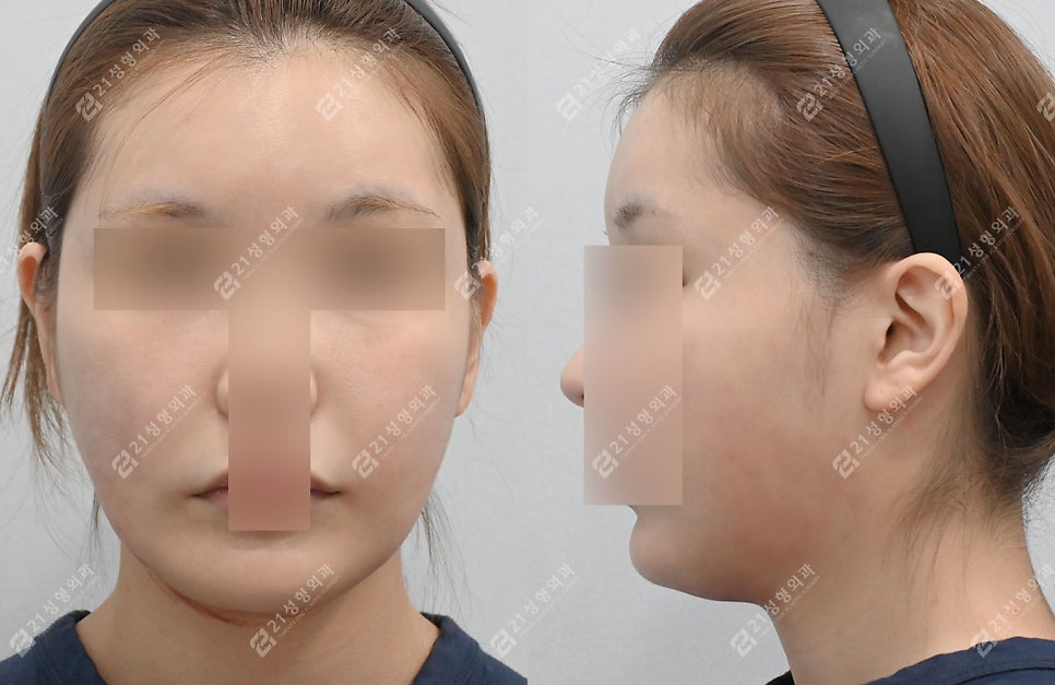 광대축소 1년 후기: 정면&middot;사선 확 달라진 리얼 변화 공개! 관련 이미지 4