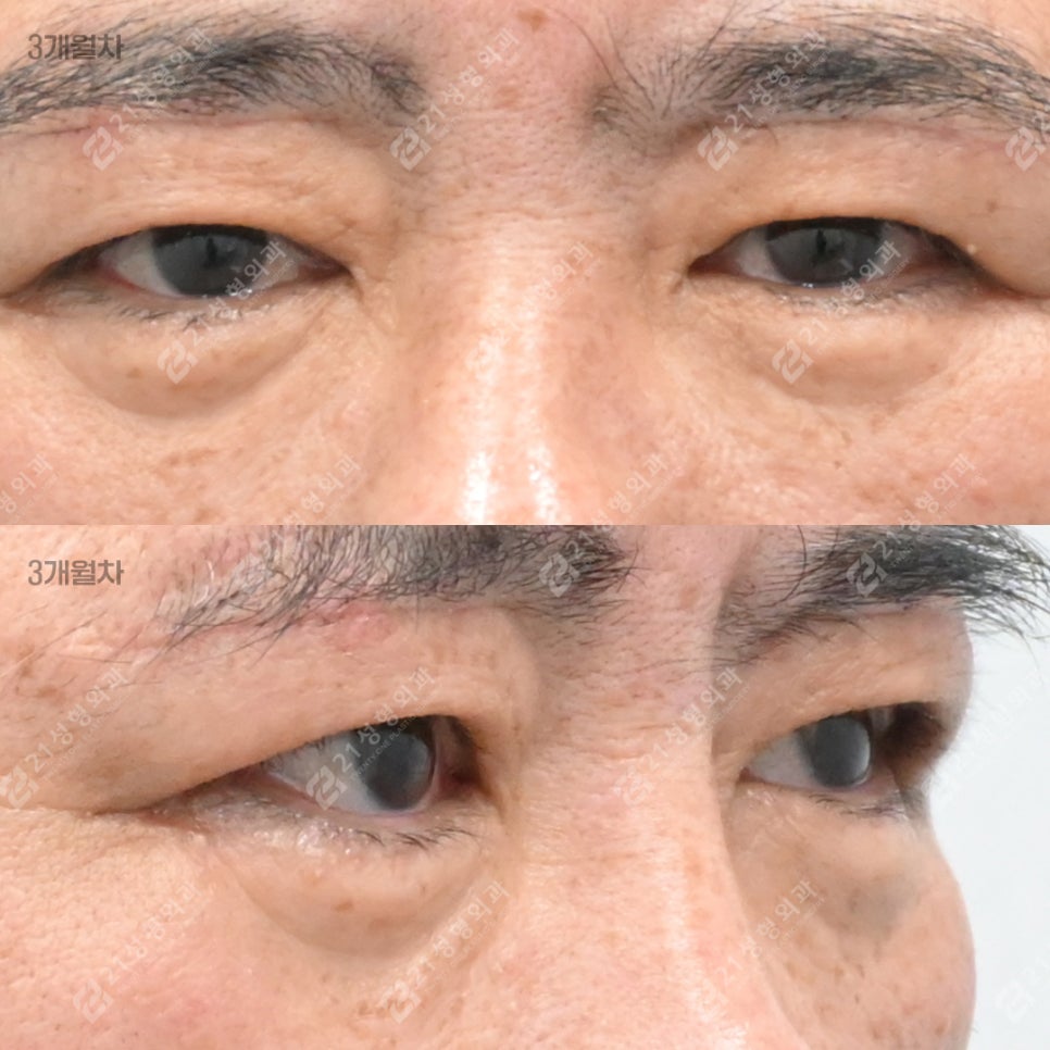 눈밑 처짐으로 인상이 무너지기 전에, 21성형외과 남성 하안검 관련 이미지 6