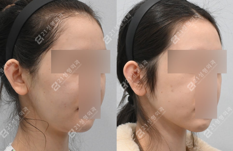 이중턱 수술 후 턱밑 피부가 접혔는데 이게 정상이라고요? 관련 이미지 3