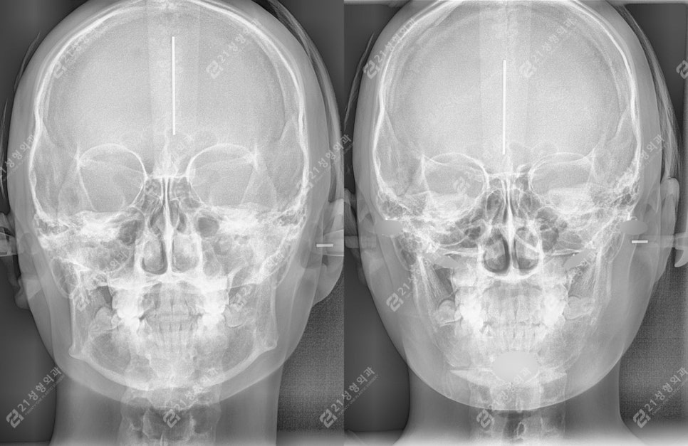Real Review of Square Jaw Surgery: Square Jaw Surgery Is Not Over After Just Shaving the Bone image 8