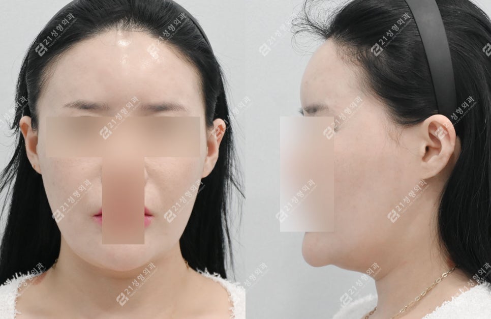 살 빼도 안 없어지는 이중턱, 정확한 진단이 먼저입니다! 관련 이미지 2