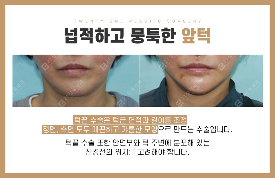 부작용 없는 안면윤곽성형외과 고르는 꿀팁용 관련 이미지 9