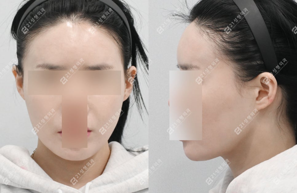 살 빼도 안 없어지는 이중턱, 정확한 진단이 먼저입니다! 관련 이미지 4