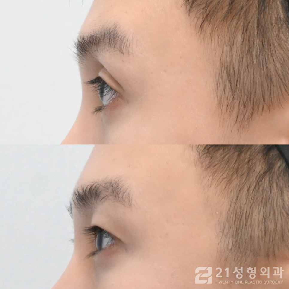쌍수라인낮추기 자연스러운 눈매의 핵심 관련 이미지 3