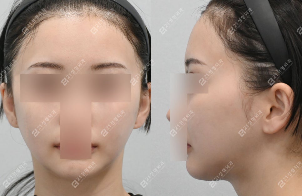 작은 얼굴이지만 윤곽 3종이 필요한 케이스: 턱끝 전진형 얼굴 분석 관련 이미지 4