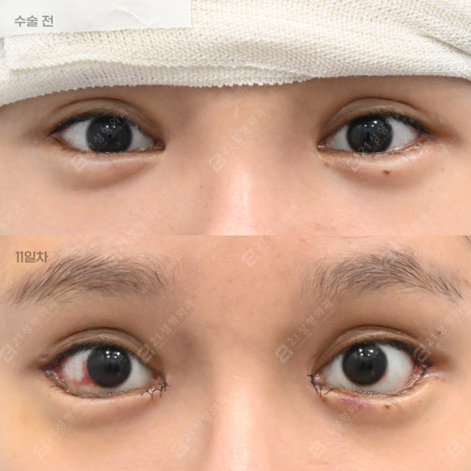 The Golden Time to Correct Failed Eye Corners? Essential Checklist for Lateral & Lower Canthoplasty Revision image 4