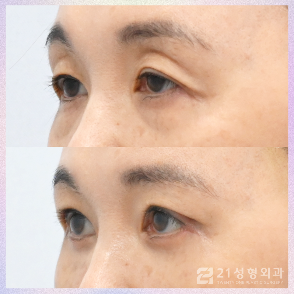 강남눈꺼풀수술 처지고 꺼진 눈매가 고민이라면 관련 이미지 3