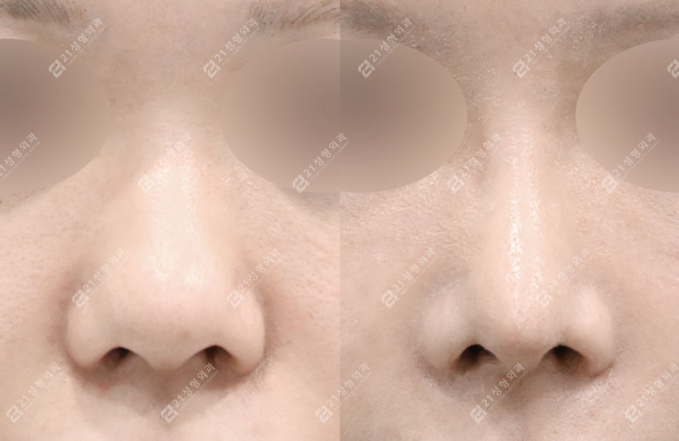 How to Create a Flawless Nose Line | Real Review of Rib Cartilage Rhinoplasty image 1