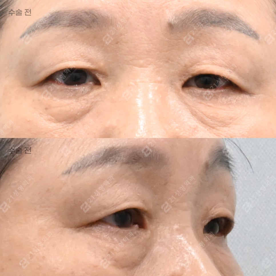Do Your Eyes Feel Heavy and Constricted? 21 Plastic Surgery Explains How to Self-Assess for a Sub-Brow Lift image 5