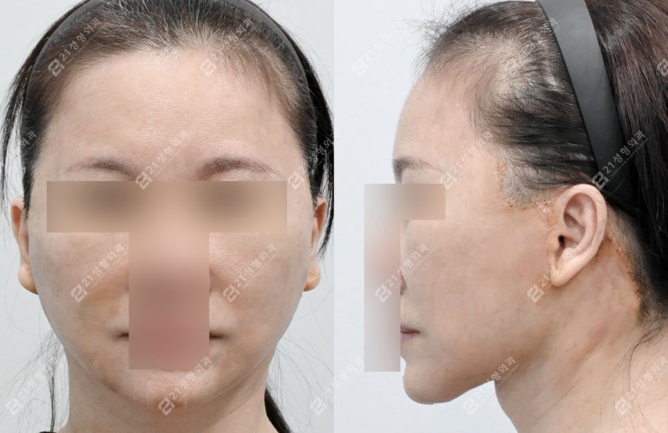 A Face That Needed a Lift, Not a Thread Lift — and There Was a Reason image 3