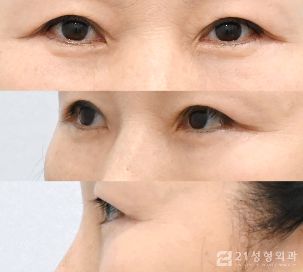 강남하안검수술 생기있는 눈매로 개선하는 방법 관련 이미지 5