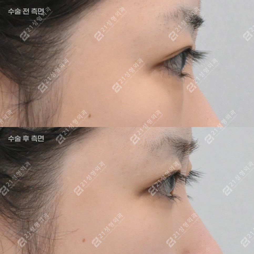 Will Under-Eye Fat Repositioning Improve the Appearance of a Tired-Looking Face? image 2