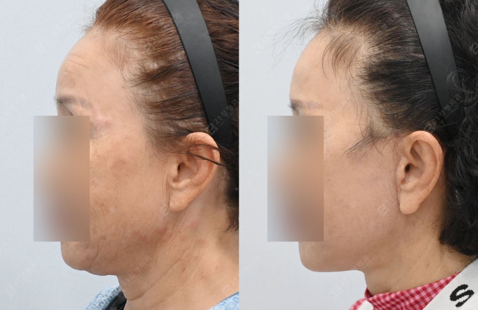 Let’s Address Facial Sagging from the Root Cause! Real Changes from a Face and Neck Lift image 7
