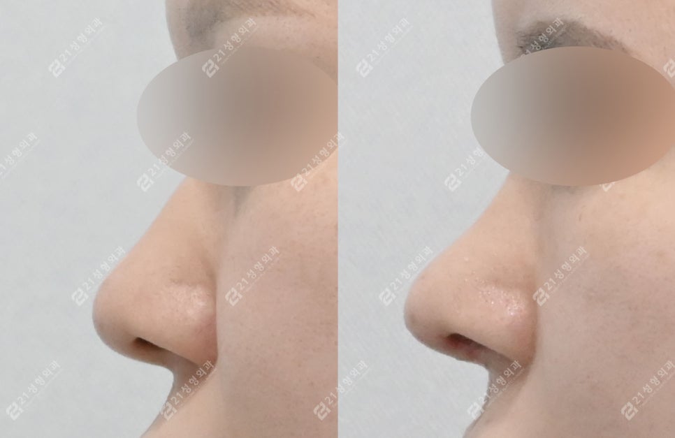 How to Create a Flawless Nose Line | Real Review of Rib Cartilage Rhinoplasty image 7