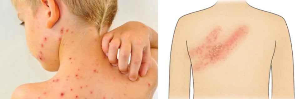 [항 바이러스제] herpes virus (헤르페스 바이러스) ② 관련 이미지 7