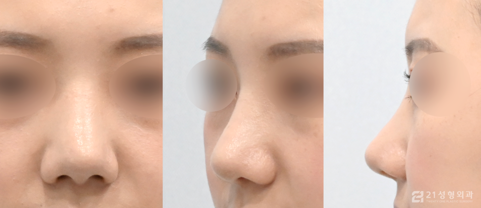 코성형잘하는곳 개인에게 맞는 자연스러운 비율 관련 이미지 5